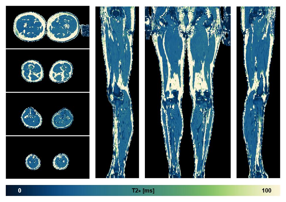 The T2 star relaxation time of the lower extremity obtained from the dixon reconstruction for muscle water fat quantification.